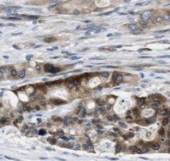 Immunohistochemistry: Syntaxin Binding Protein 4 Antibody - BSA Free [NBP3-45782] - Immunohistochemistry of paraffin-embedded human pancreas cancer using (Syntaxin Binding Protein 4 antibody) at dilution of 1:100