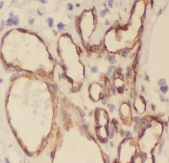 Immunohistochemistry: Stomatin-like protein 1 Antibody - BSA Free [NBP3-45789] - Immunohistochemistry of paraffin-embedded human gliomas using (Stomatin-like protein 1 antibody) at dilution of 1:100