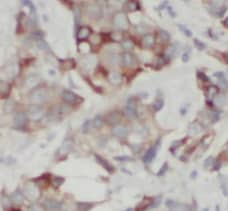 Immunohistochemistry: STARD3NL Antibody - BSA Free [NBP3-45802] - Immunohistochemistry of paraffin-embedded human breast cancer using (STARD3NL antibody) at dilution of 1:100