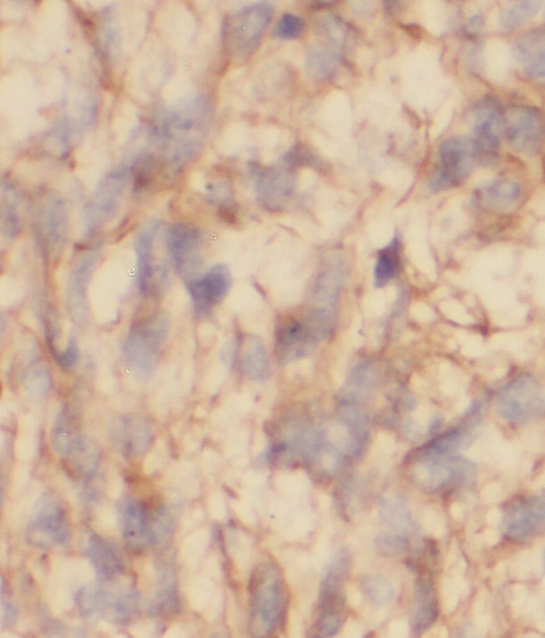 Immunohistochemistry: STAC3 Antibody - BSA Free [NBP3-45803] - Immunohistochemistry of paraffin-embedded human gliomas using (STAC3 antibody) at dilution of 1:50