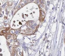 Immunohistochemistry: Signal sequence receptor delta Antibody - BSA Free [NBP3-45814] - Immunohistochemistry of paraffin-embedded human pancreas cancer using (Signal sequence receptor delta antibody) at dilution of 1:50
