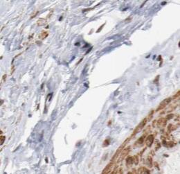 Immunohistochemistry: SS18L2 Antibody - BSA Free [NBP3-45815] - Immunohistochemistry of paraffin-embedded human prostate cancer using (SS18L2 antibody) at dilution of 1:50