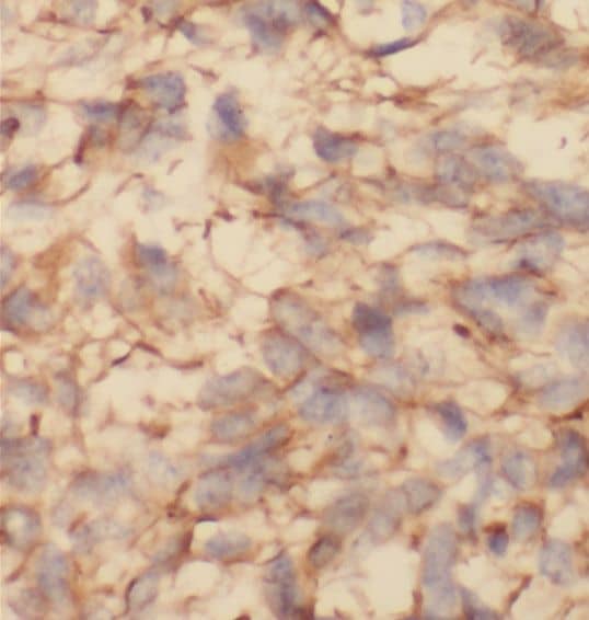 Immunohistochemistry: SRP68 Antibody - BSA Free [NBP3-45818] - Immunohistochemistry of paraffin-embedded human gliomas using (SRP68 antibody) at dilution of 1:100