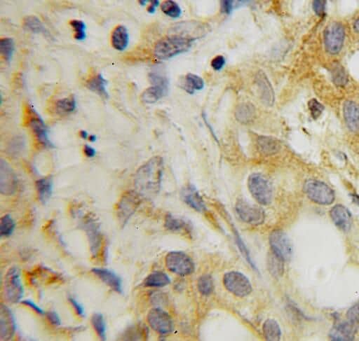 Immunohistochemistry: SRFBP1 Antibody - BSA Free [NBP3-45821] - Immunohistochemistry of paraffin-embedded human pancreas cancer using (SRFBP1 antibody) at dilution of 1:100