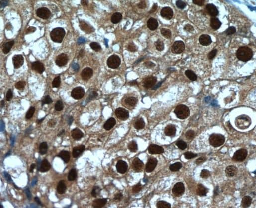 Immunohistochemistry: SRA1 Antibody - BSA Free [NBP3-45822] - Immunohistochemistry of paraffin-embedded human breast cancer tissue slide using (SRA1 Antibody) at dilution of 1:50
