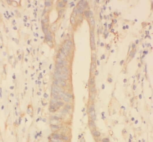 Immunohistochemistry: SPRR3 Antibody - BSA Free [NBP3-45827] - Immunohistochemistry of paraffin-embedded human colon cancer using (SPRR3 antibody) at dilution of 1:100
