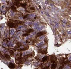 Immunohistochemistry: SPIN1 Antibody - BSA Free [NBP3-45837] - Immunohistochemistry of paraffin-embedded human ovary tumor using (SPIN1 antibody) at dilution of 1:100