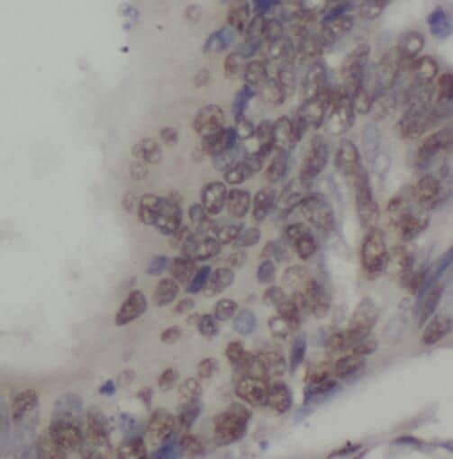 Immunohistochemistry: Sperm-associated antigen 7 Antibody - BSA Free [NBP3-45854] - Immunohistochemistry of paraffin-embedded human colon cancer using (Sperm-associated antigen 7 antibody) at dilution of 1:50