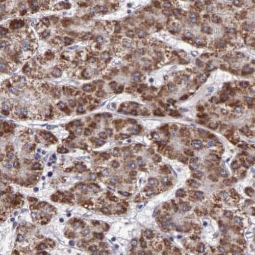 Immunohistochemistry: SMCR7 Antibody - BSA Free [NBP3-45887] - Immunohistochemistry of paraffin-embedded human liver cancer tissue slide using (SMCR7 Antibody) at dilution of 1:50