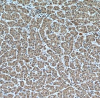 Immunohistochemistry: MKS1 Antibody - BSA Free [NBP3-45910] - Immunohistochemistry of paraffin-embedded human liver cancer using (MKS1 antibody) at dilution of 1:50