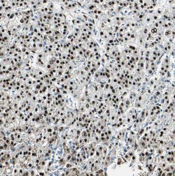 Immunohistochemistry: MIPOL1 Antibody - BSA Free [NBP3-45912] - Immunohistochemistry of paraffin-embedded human liver cancer using (MIPOL1 antibody) at dilution of 1:100