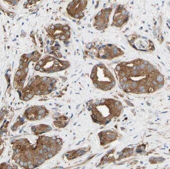 Immunohistochemistry: MIPEP Antibody - BSA Free [NBP3-45913] - Immunohistochemistry of paraffin-embedded human prostate cancer using (MIPEP antibody) at dilution of 1:50