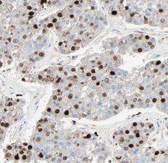 Immunohistochemistry: MIER1 Antibody - BSA Free [NBP3-45915] - Immunohistochemistry of paraffin-embedded human pancreas cancer tissue slide using (MIER1 Antibody) at dilution of 1:50
