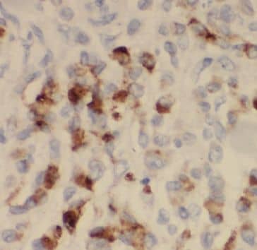 Immunohistochemistry: MICAL2 Antibody - BSA Free [NBP3-45918] - Immunohistochemistry of paraffin-embedded human stomach cancer slide using (MICAL2 Antibody) at dilution of 1:50
