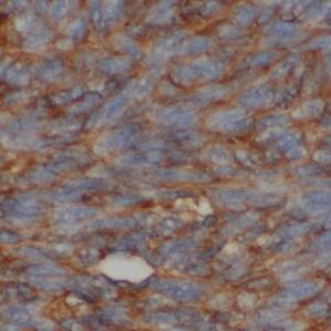 Immunohistochemistry: Ly-6E Antibody - BSA Free [NBP3-45986] - Immunohistochemistry of paraffin-embedded human liver cancer tissue slide using (LY6E Antibody) at dilution of 1:200 heat mediated antigen retrieved with Tris-EDTA buffer(Ly-6E