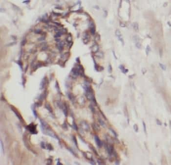 Immunohistochemistry: IFIT1 Antibody - BSA Free [NBP3-46054] - Immunohistochemistry of paraffin-embedded human breast cancer slide using (IFIT1 Antibody) at dilution of 1:50