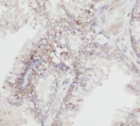 Immunohistochemistry: HSDL2 Antibody - BSA Free [NBP3-46071] - Immunohistochemistry of paraffin-embedded human prostate cancer using (HSDL2 antibody) at dilution of 1:100