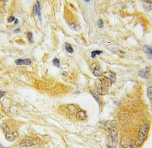 Immunohistochemistry: Hippocalcin like 4 Antibody - BSA Free [NBP3-46088] - Immunohistochemistry of paraffin-embedded human medulloblastoma using (Hippocalcin like 4 antibody) at dilution of 1:100