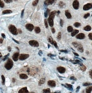 Immunohistochemistry: hnRNP H Antibody - BSA Free [NBP3-46098] - Immunohistochemistry of paraffin-embedded human cervical cancer using (hnRNP H antibody) at dilution of 1:50