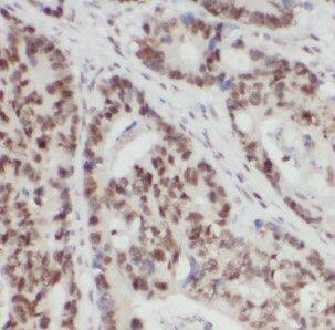 Immunohistochemistry: hnRNP F Antibody - BSA Free [NBP3-46099] - Immunohistochemistry of paraffin-embedded human colon cancer using (hnRNP F antibody) at dilution of 1:50