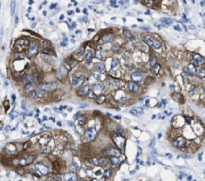 Immunohistochemistry: Hephaestin Antibody - BSA Free [NBP3-46128] - Immunohistochemistry of paraffin-embedded human pancreas cancer tissue slide using ( Hephaestin Antibody) at dilution of 1:50