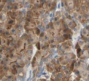Immunohistochemistry: GSTA2 Antibody - BSA Free [NBP3-46168] - Immunohistochemistry of paraffin-embedded human prostate cancer using (GSTA2 antibody) at dilution of 1:100