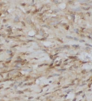 Immunohistochemistry: GOSR1 Antibody - BSA Free [NBP3-46171] - Immunohistochemistry of paraffin-embedded human stomach cancer using (GOSR1 antibody) at dilution of 1:50