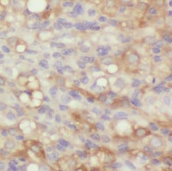 Immunohistochemistry: GRB 14 Antibody - BSA Free [NBP3-46175] - Immunohistochemistry of paraffin-embedded human ovary tumor using (GRB 14 antibody) at dilution of 1:50