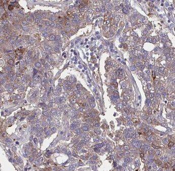 Immunohistochemistry: GPSM2 Antibody - BSA Free [NBP3-46180] - Immunohistochemistry of paraffin-embedded human pancreas cancer using (GPSM2 antibody) at dilution of 1:50