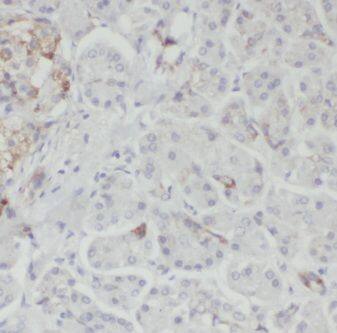 Immunohistochemistry: GNB1 Antibody - BSA Free [NBP3-46209] - Immunohistochemistry of paraffin-embedded human pancreas cancer using (GNB1 antibody) at dilution of 1:100