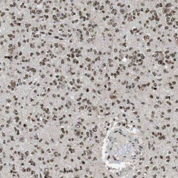 Immunohistochemistry: GDAP1L1 Antibody - BSA Free [NBP3-46246] - Immunohistochemistry of paraffin-embedded human gliomas using (GDAP1L1 antibody) at dilution of 1:50