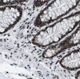 Immunohistochemistry: NOLA1 Antibody - BSA Free [NBP3-46262] - Immunohistochemistry of paraffin-embedded human skin cancer using (NOLA1 antibody) at dilution of 1:50