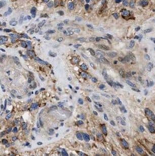 Immunohistochemistry: GABA-A R gamma 1 Antibody - BSA Free [NBP3-46277] - Immunohistochemistry of paraffin-embedded human gliomas using (GABA-A R gamma 1 antibody) at dilution of 1:100