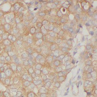 Immunohistochemistry: FXYD3 Antibody - BSA Free [NBP3-46285] - Immunohistochemistry of paraffin-embedded human breast cancer using (FXYD3 antibody) at dilution of 1:100