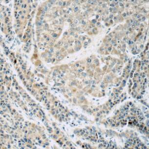 Immunohistochemistry: QBRICK/FREM1 Antibody - BSA Free [NBP3-46296] - Immunohistochemistry of paraffin-embedded human liver cancer tissue slide using (QBRICK/FREM1 Antibody) at dilution of 1:50