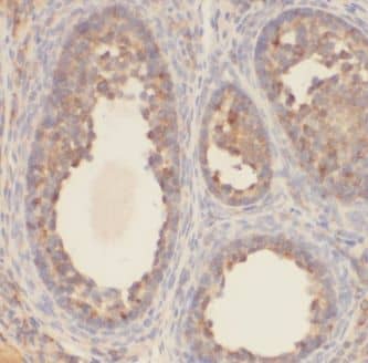 Immunohistochemistry: KCTD5 Antibody - BSA Free [NBP3-46419] - Immunohistochemistry of paraffin-embedded human ovary tumor using (KCTD5 antibody) at dilution of 1:50