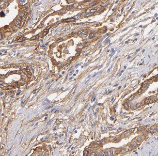 Immunohistochemistry: Kv5.1 Antibody - BSA Free [NBP3-46431] - Immunohistochemistry of paraffin-embedded human pancreas cancer using (Kv5.1 antibody) at dilution of 1:100