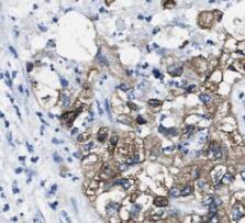 Immunohistochemistry: JSRP1 Antibody - BSA Free [NBP3-46443] - Immunohistochemistry of paraffin-embedded human pancreas cancer using (JSRP1 antibody) at dilution of 1:50