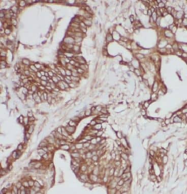 Immunohistochemistry: IQCK Antibody - BSA Free [NBP3-46461] - Immunohistochemistry of paraffin-embedded human colon cancer tissue slide using (IQCK Antibody) at dilution of 1:50