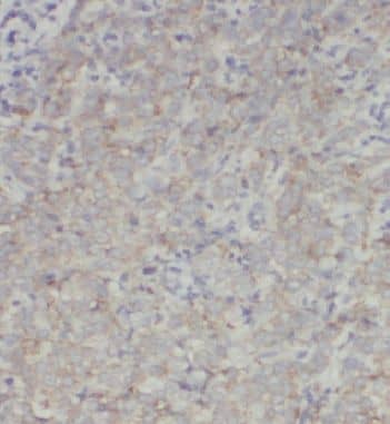 Immunohistochemistry: INO80C Antibody - BSA Free [NBP3-46480] - Immunohistochemistry of paraffin-embedded human breast cancer tissue slide using (INO80C Antibody) at dilution of 1:50