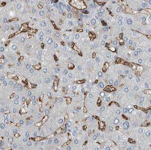 Immunohistochemistry: IGHMBP2 Antibody - BSA Free [NBP3-46486] - Immunohistochemistry of paraffin-embedded human liver cancer tissue slide using (IGHMBP2 Antibody) at dilution of 1:50