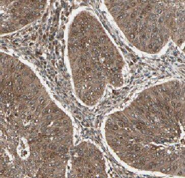 Immunohistochemistry: FAM168B Antibody - BSA Free [NBP3-46513] - Immunohistochemistry of paraffin-embedded human cervical cancer tissue (FAM168B antibody) at dilution of 1:50