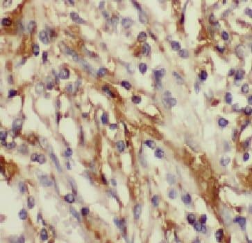 Immunohistochemistry: FAM156A Antibody - BSA Free [NBP3-46517] - Immunohistochemistry of paraffin-embedded human lung cancer tissue (FAM156A antibody) at dilution of 1:100
