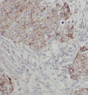 Immunohistochemistry: FAM117B Antibody - BSA Free [NBP3-46527] - Immunohistochemistry of paraffin-embedded human breast cancer using (FAM117B antibody) at dilution of 1:50