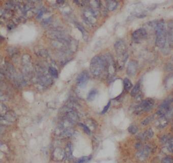 Immunohistochemistry: Ext2 Antibody - BSA Free [NBP3-46537] - Immunohistochemistry of paraffin-embedded human colon cancer using (Ext2 antibody) at dilution of 1:50