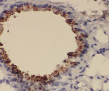 Immunohistochemistry: Exosome component 1 Antibody - BSA Free [NBP3-46539] - Immunohistochemistry of paraffin-embedded human lymphoma using (Exosome component 1 antibody) at dilution of 1:100