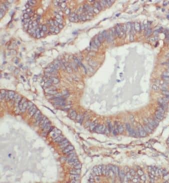 Immunohistochemistry: ERGIC1 Antibody - BSA Free [NBP3-46556] - Immunohistochemistry of paraffin-embedded human colon cancer using (ERGIC1 antibody) at dilution of 1:100