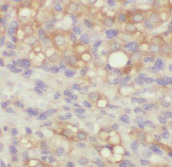 Immunohistochemistry: EMILIN1 Antibody - BSA Free [NBP3-46573] - Immunohistochemistry of paraffin-embedded human ovary tumor using (EMILIN1 antibody) at dilution of 1:100