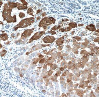 Immunohistochemistry: ELOVL6 Antibody - BSA Free [NBP3-46575] - Immunohistochemistry of paraffin-embedded human hepatocirrhosis using (ELOVL6 antibody) at dilution of 1:100