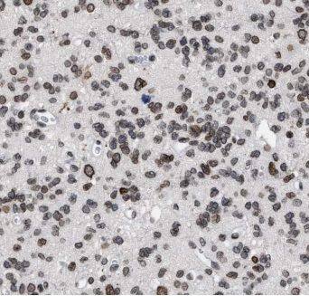 Immunohistochemistry: ELMOD1 Antibody - BSA Free [NBP3-46578] - Immunohistochemistry of paraffin-embedded human gliomas using (ELMOD1 antibody) at dilution of 1:100